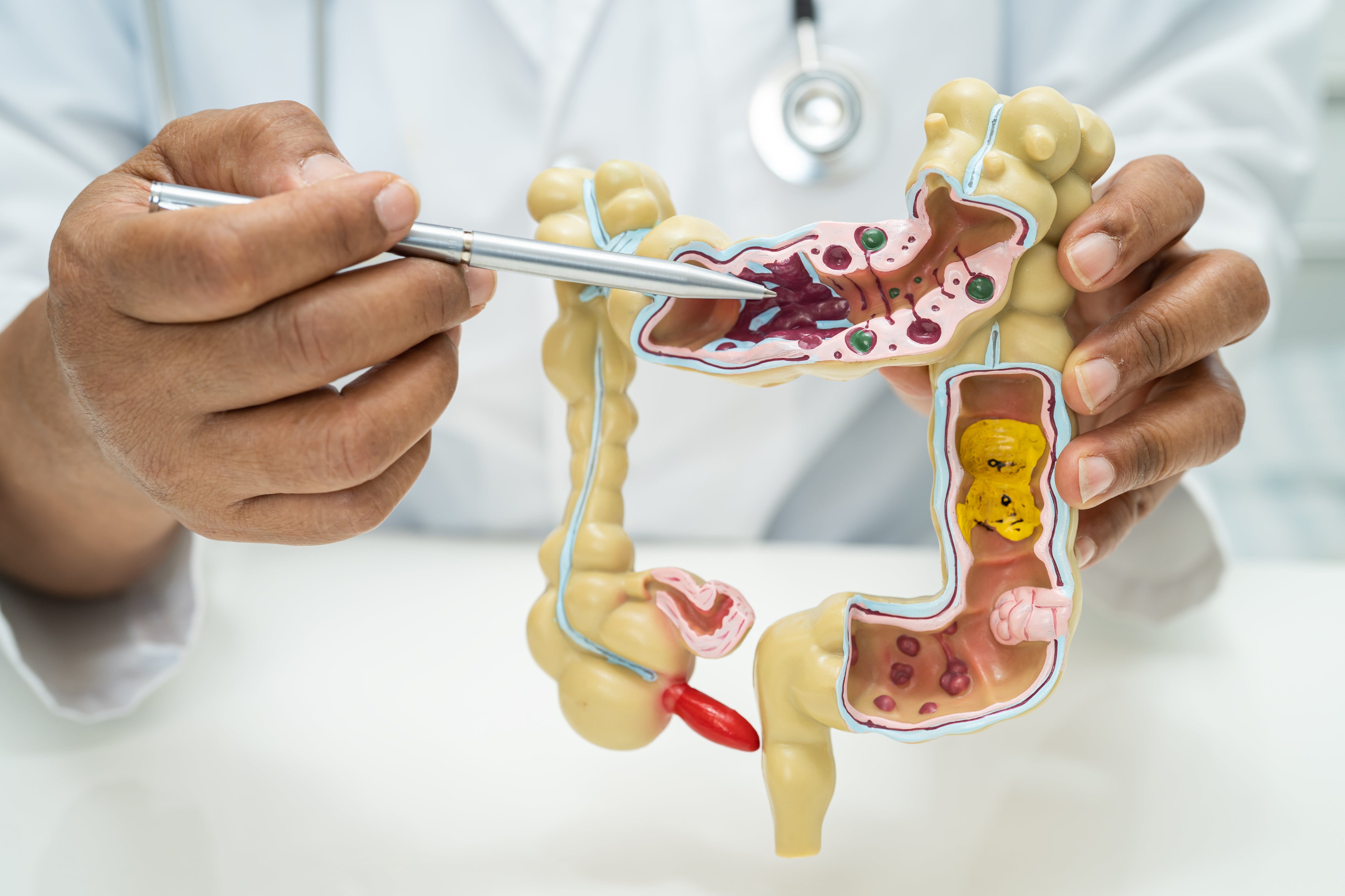Can Bio-Well Identify Colon Tumors? What the Biomedical Engineering Study Found